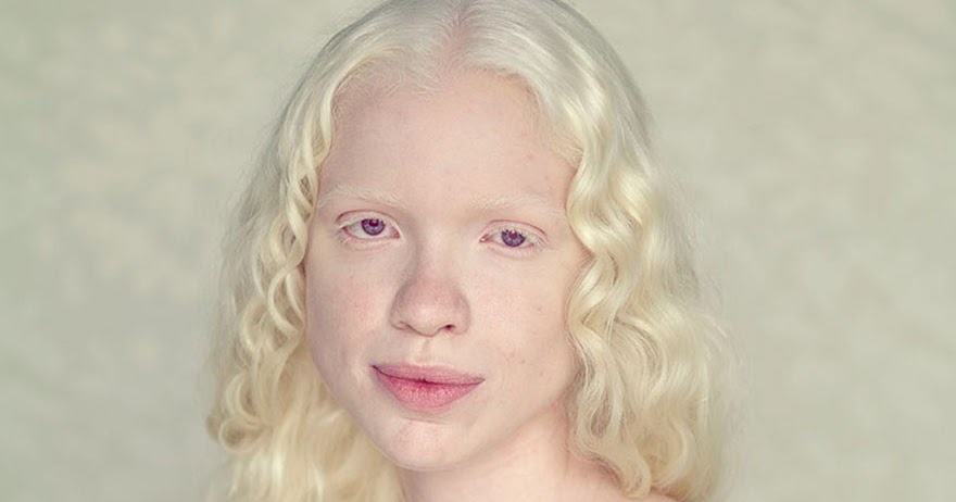 Человек - альбинос: 8 типов альбинизма, 4 ведущих симптома и о прогнозе жизни для особенных людей