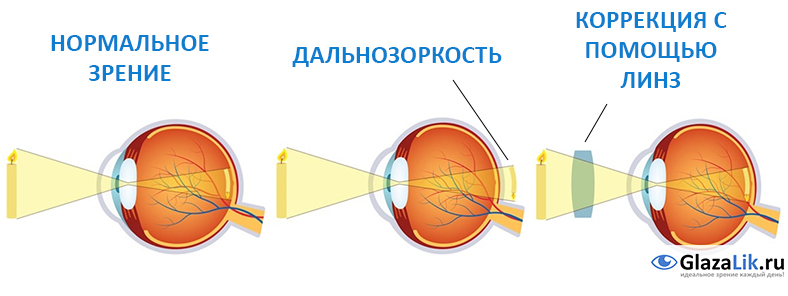 Коррекция зрения с помощью линз