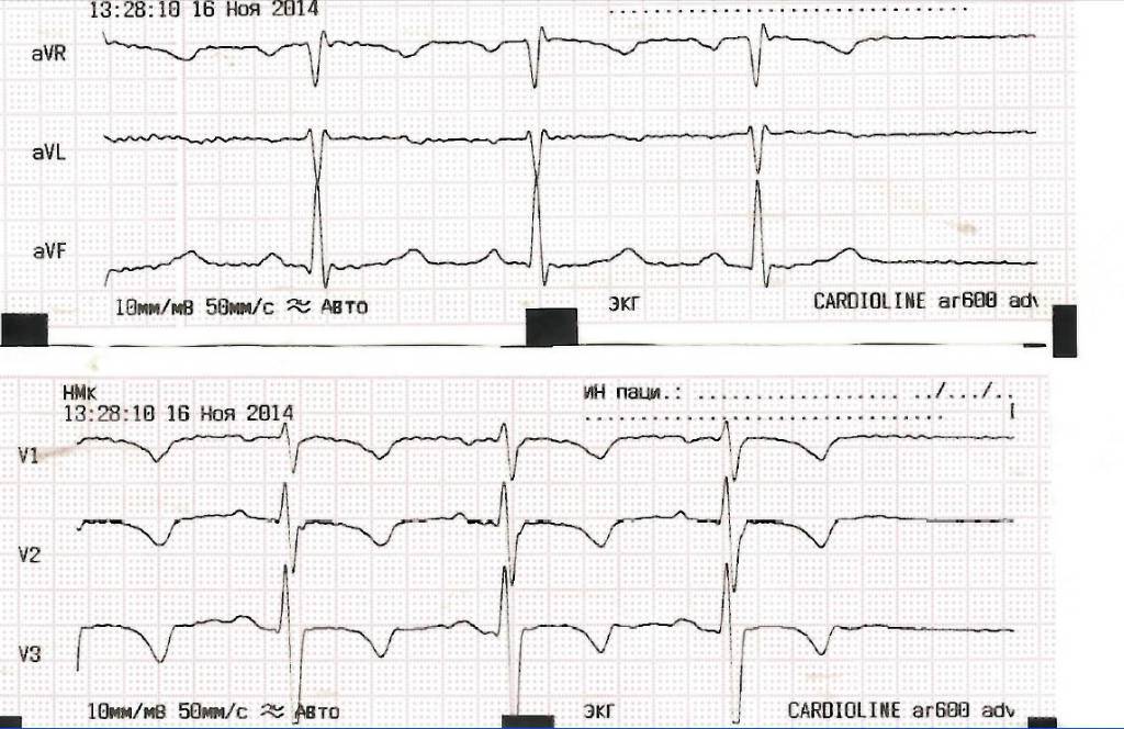 Экг сердца норма фото