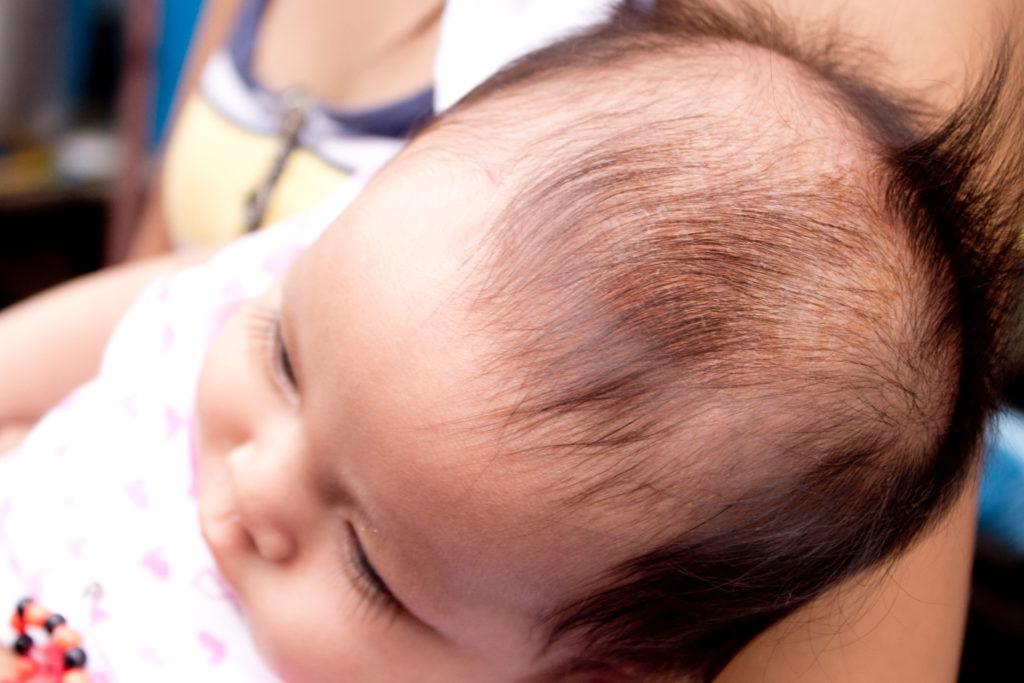 Корочка на голове у грудничка: причины чешуек у новорожденного ребенка, масло, шампунь, крем, гель и другие средства для лечения желтых корочек - детская поликлиника