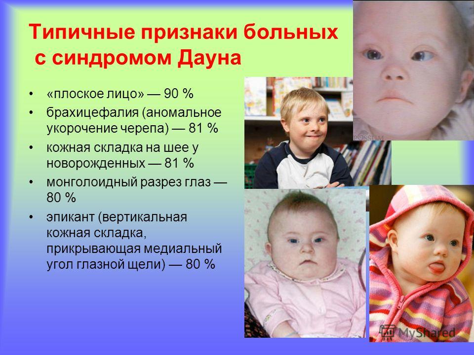 Дети дауны признаки фото