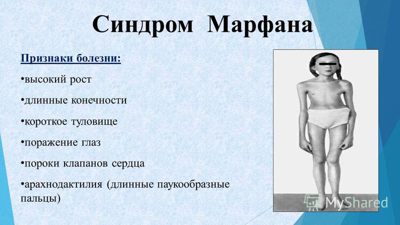 Синдром ретта у детей: общие сведения и симптомы