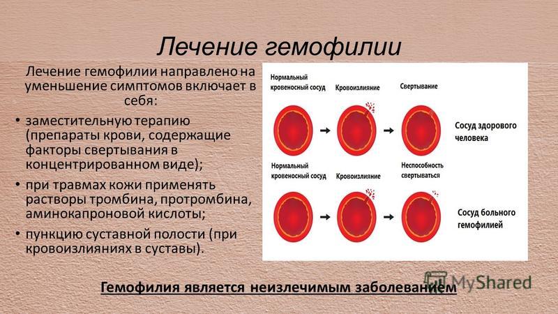 Гемофильная инфекция у детей - симптомы болезни, профилактика и лечение гемофильной инфекции у детей, причины заболевания и его диагностика на eurolab