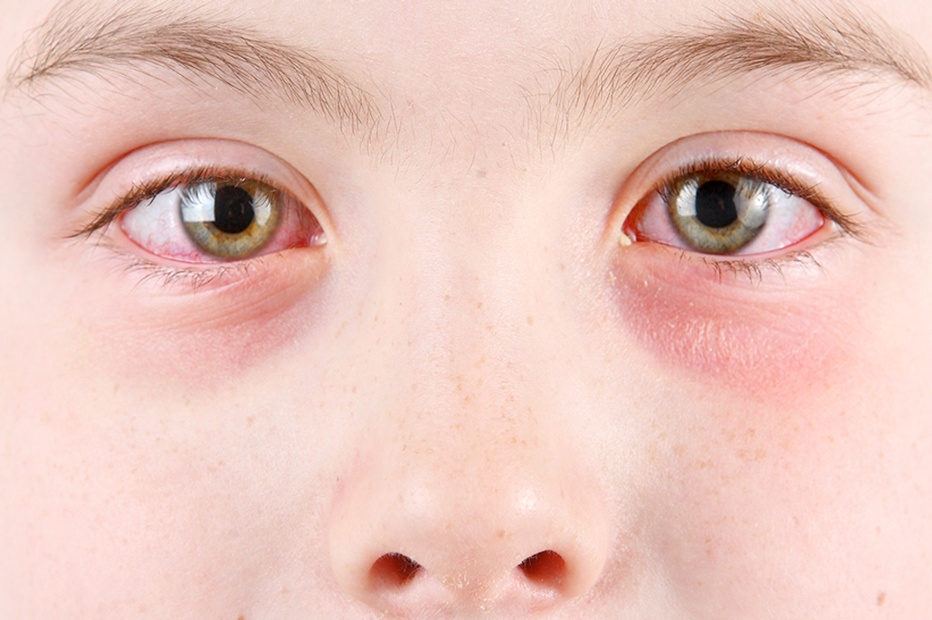 Аллергический конъюнктивит у детей