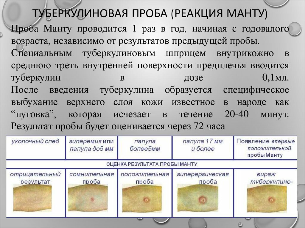 Сделать манту ребенку. Реакция манту норма у детей 5 лет. Прививка манту какая нормальная Размеры у детей. Реакция норма туберкулиновой пробы. Реакция манту норма у детей 1 года.