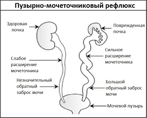 Гидронефроз клиническая картина