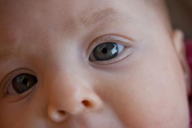 Косоглазие у новорождённых — патология или норма?
