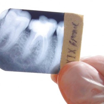 Ретинированные зубы: симптомы, диагностика и удаление ретинированного зуба