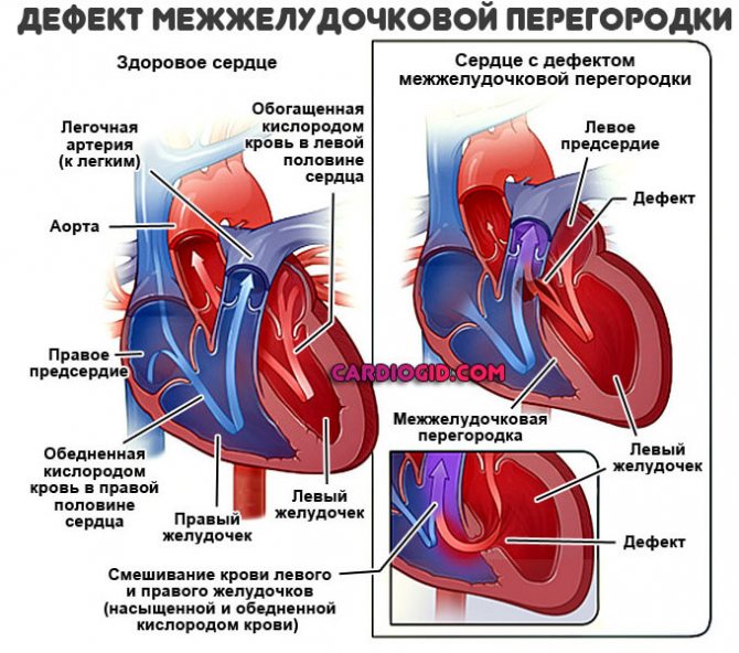 Шумы в сердце: виды, причины, диагностика