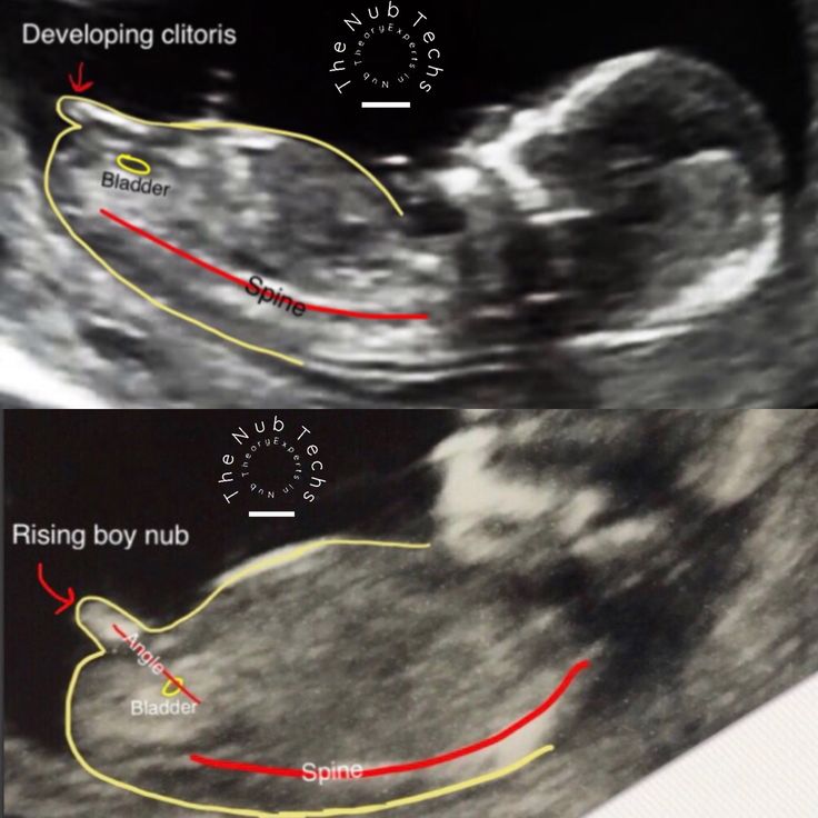 Можно ли определить пол ребенка по узи при беременности в 12 недель