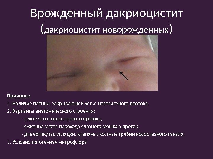 Для чего делают промывание слезного канала?