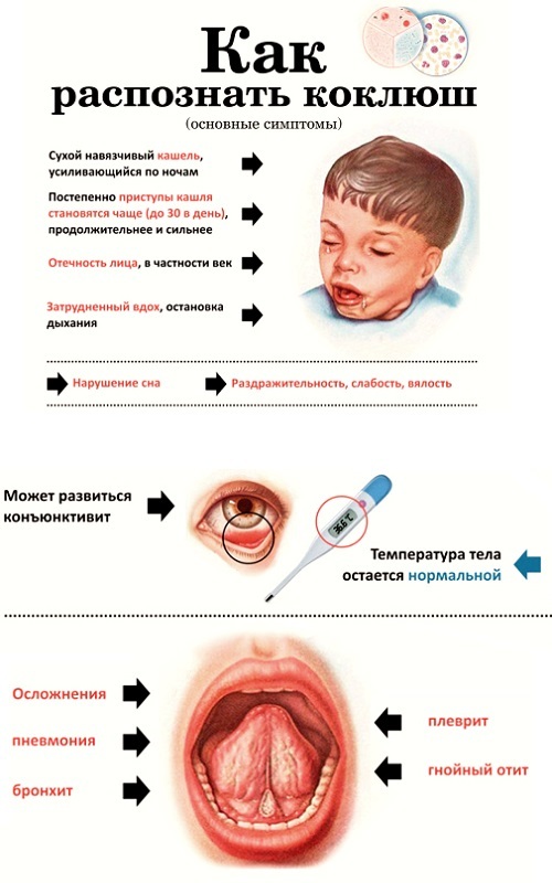 Коклюш симптомы у детей фото