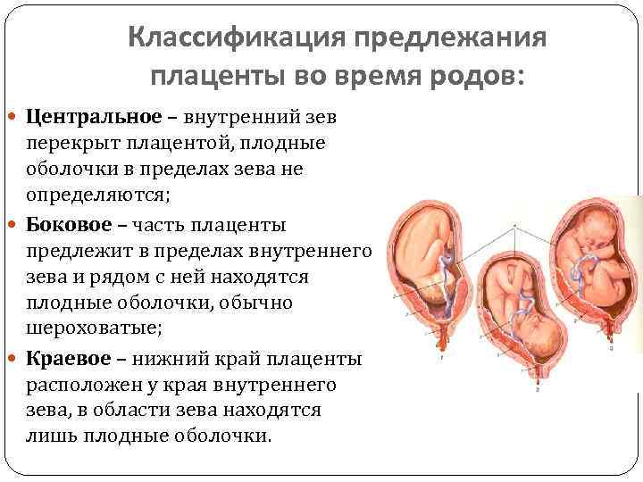 Низкая плацентация фото