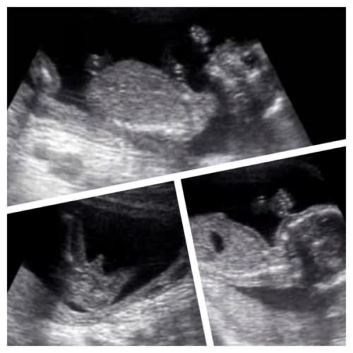 17 неделя беременности: что происходит с малышом (17 фото): развитие плода, размер, где находится и как выглядит ребенок