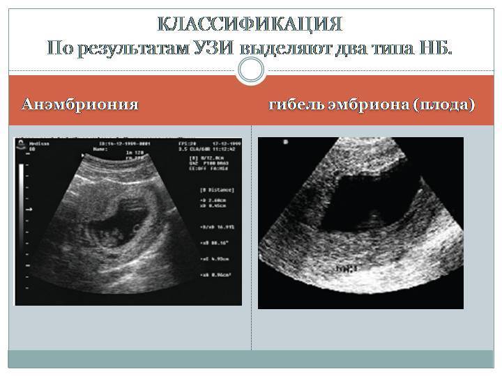 Замершая беременность | eurolab | гинекология