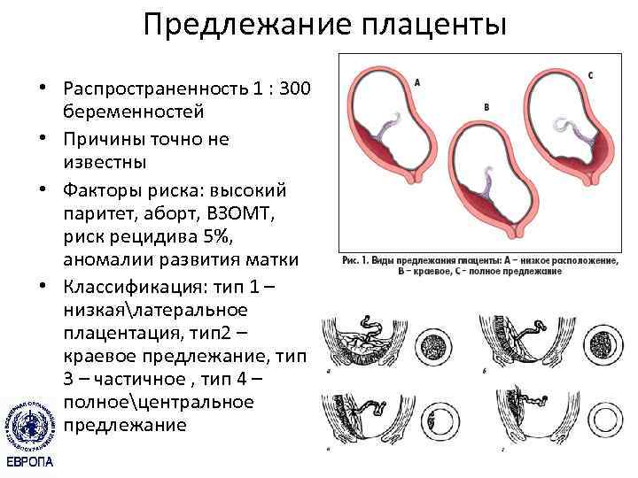 Клиническая картина предлежания плаценты