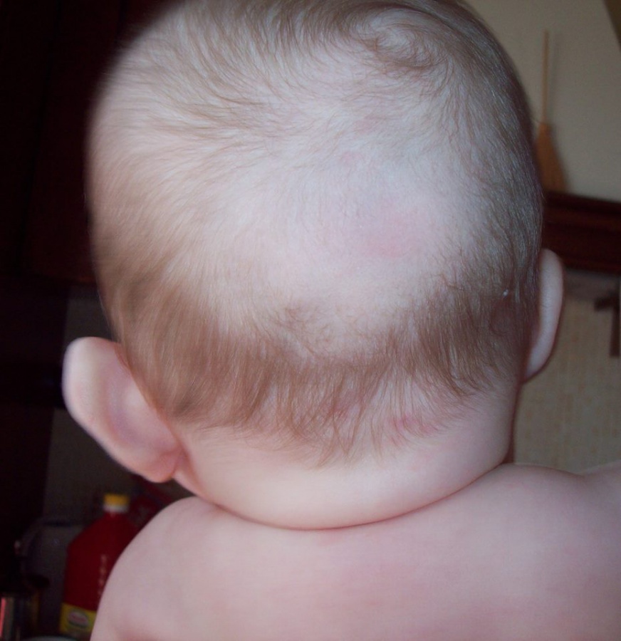 Как избавиться от волос на спине у ребенка? волосы или щетина на спине у новорожденного: причины появления и способы удаления у маленькой девочки растут волосы на ногах