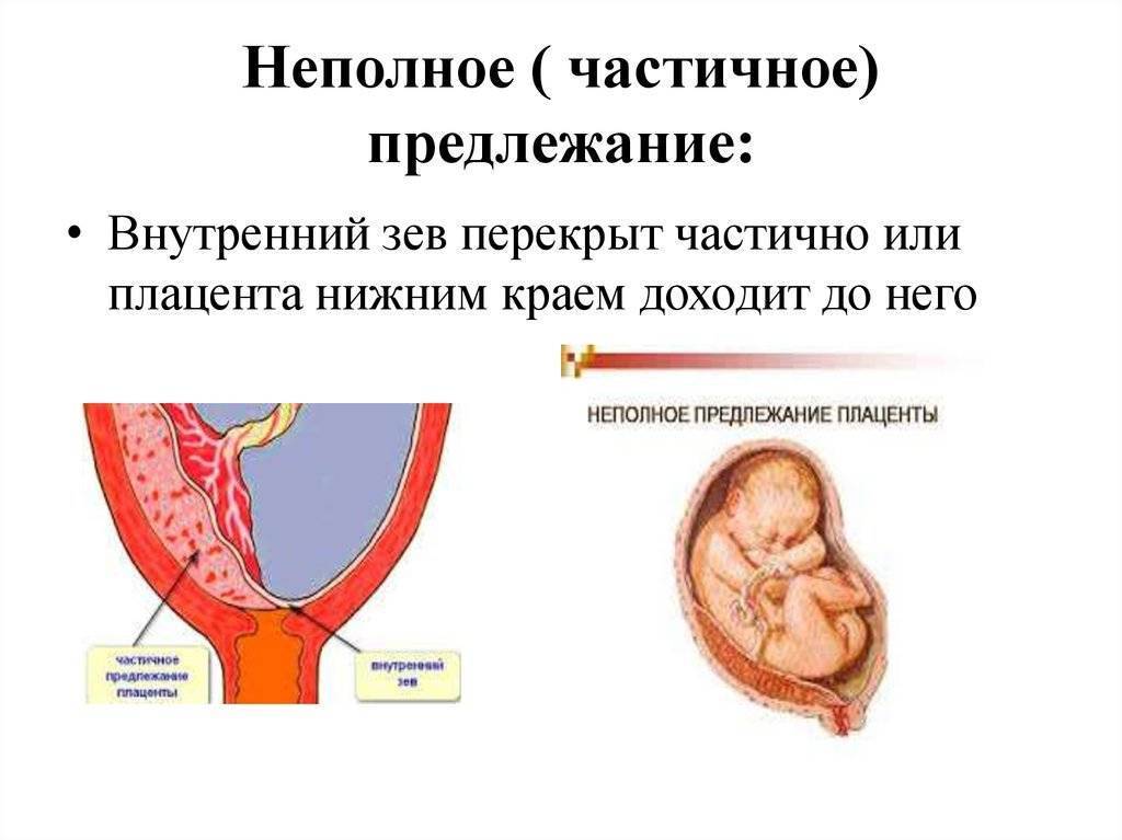 Предлежание плаценты картинки