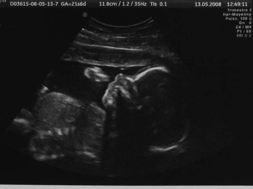 22 недели беременности фото узи