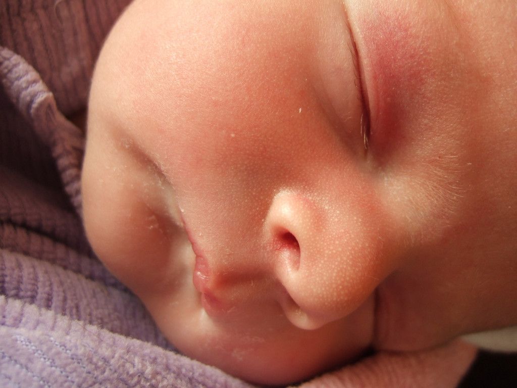 Мозоль на губе у новорожденного, грудничка: причины и лечение