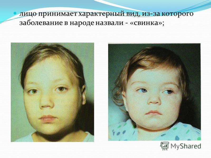 Свинка (паротит эпидемический)