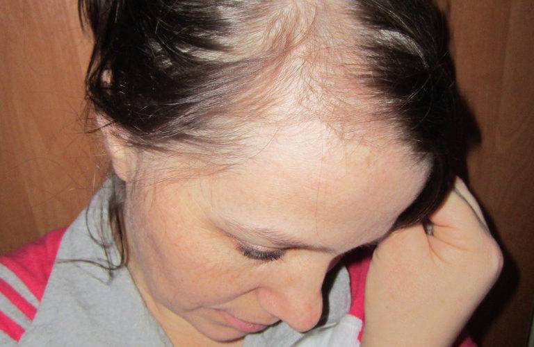 Выпадение волос при беременности: причины, лечение, профилактика
