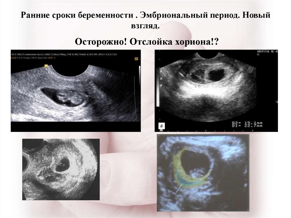 Как выглядит хорион на 6 неделе беременности фото