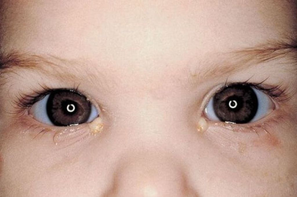 Запавшие глаза у ребенка фото