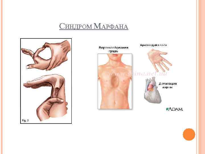 Синдром марфана -  marfan syndrome