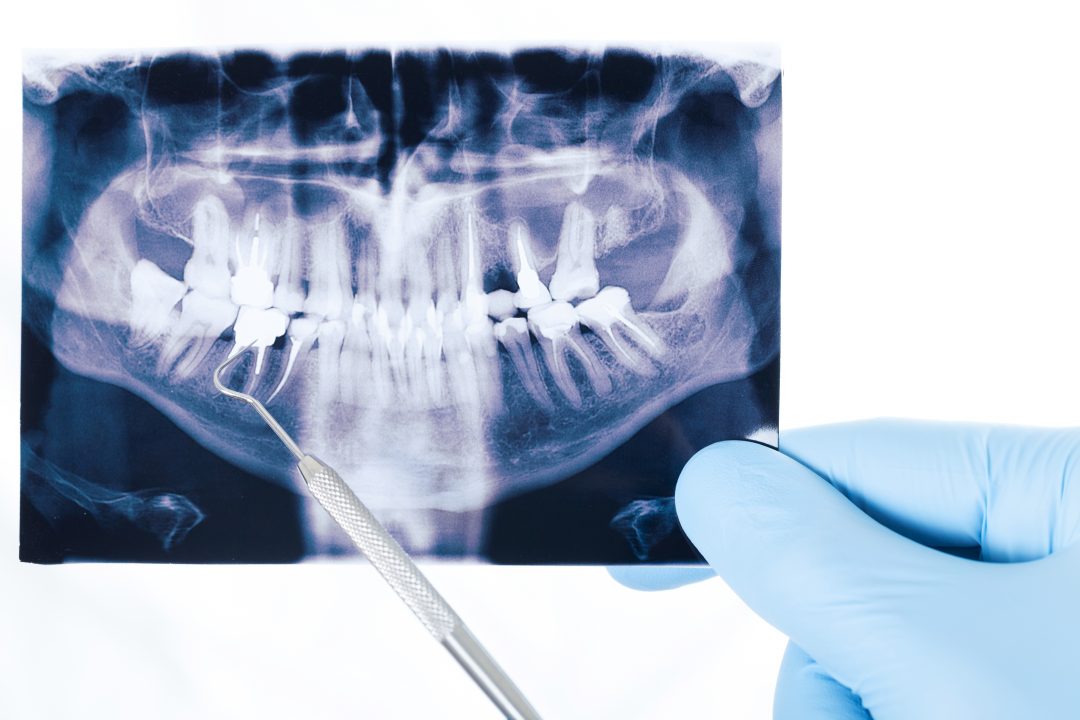 Рентген зуба при беременности: можно или нет?