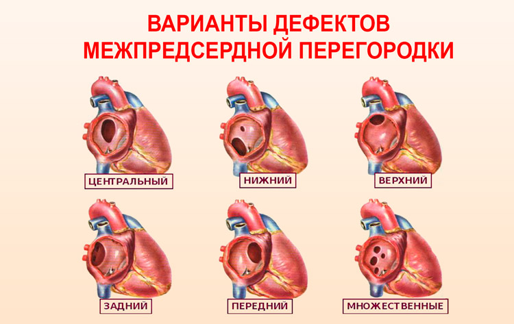 Врожденные пороки сердца у детей симптомы. классификация врожденных пороков сердца у детей и новорожденных