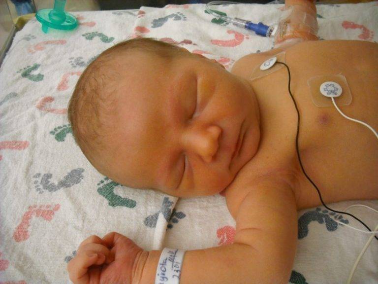 Физиологическая желтуха у новорожденных: причины и лечение