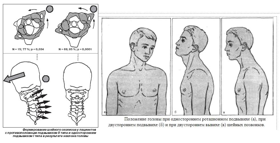 Шейный остеохондроз: симптомы, признаки и лечение остеохондроза шейного отдела