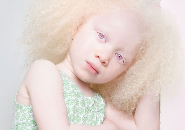 Альбинизм у ребенка: диагностика и лечение в клинике фэнтези в москве