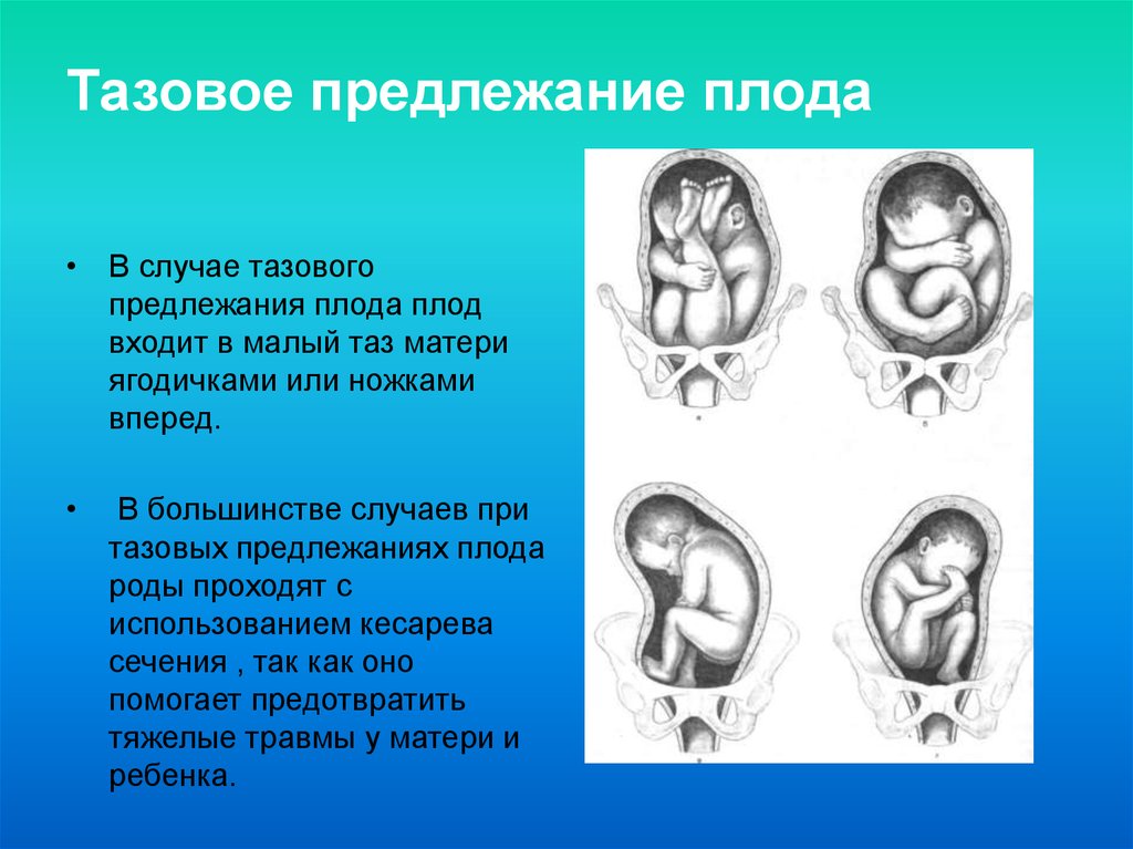 Тазово ягодичное предлежание плода фото