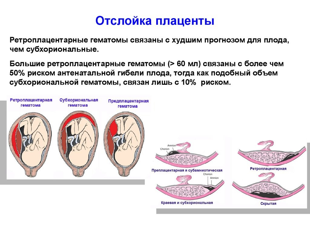 Отслойка плаценты карта вызова