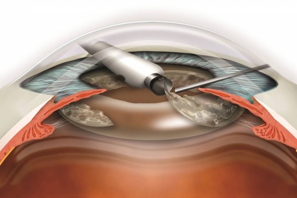 Лечение после операции катаракты