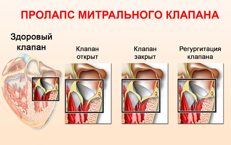 Пролапс митрального клапана у детей - признаки, причины, симптомы, лечение и профилактика - idoctor.kz