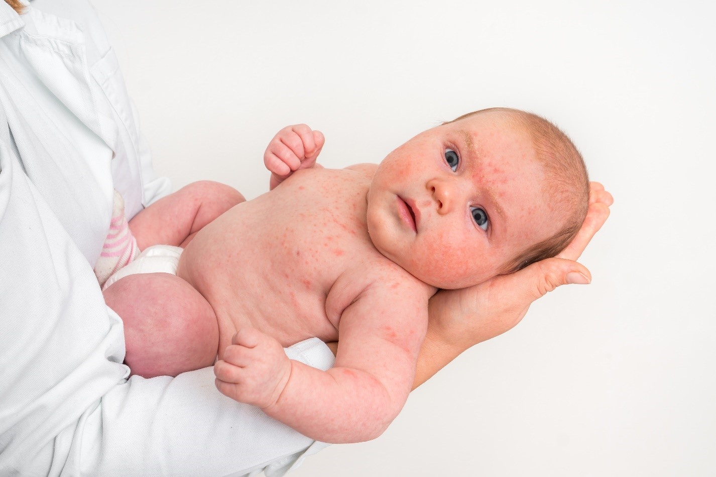 Пищевая аллергия у новорожденного