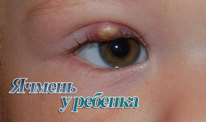 Ячмень на глазу у ребенка 2 года фото