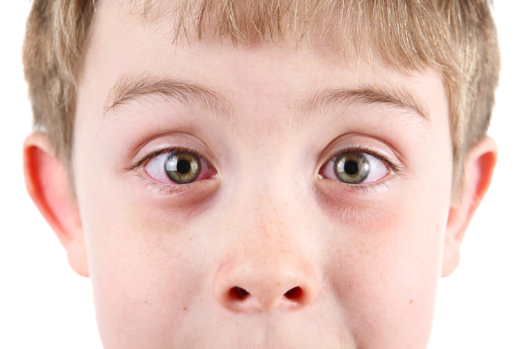 Аллергический конъюнктивит у детей - симптомы болезни, профилактика и лечение аллергического конъюнктивита у детей, причины заболевания и его диагностика на eurolab