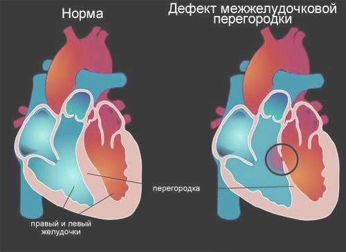 Дефект межжелудочковой перегородки (дмжп) сердца у детей и