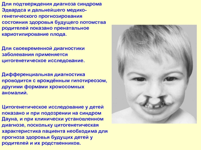 Синдром патау (трисомия по 13 хромосоме) и синдром эдвардса (трисомия по 18 хромосоме). анеуплоидия, трисомия, транслокация, мозаицизм
