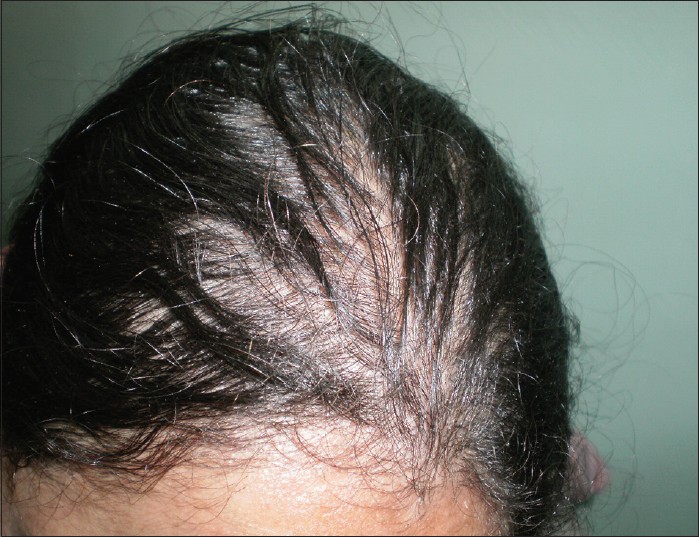 Из за миомы могут выпадать волосы на голове