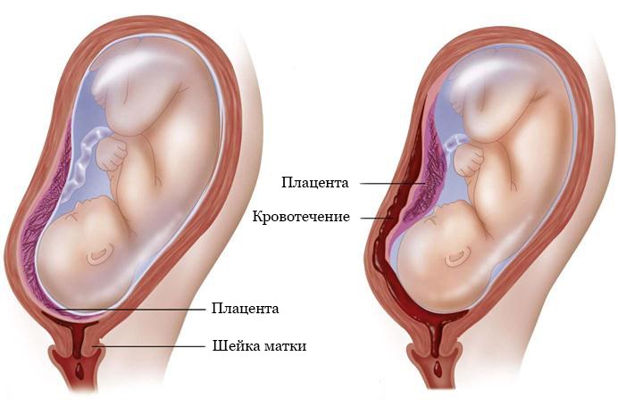 Шейка мм 31 неделя. Плацента по передней стенке матки при беременности. Хорион плацента матка. Головное предлежание плода плацента по передней стенке. Переднее прикрепление плаценты.