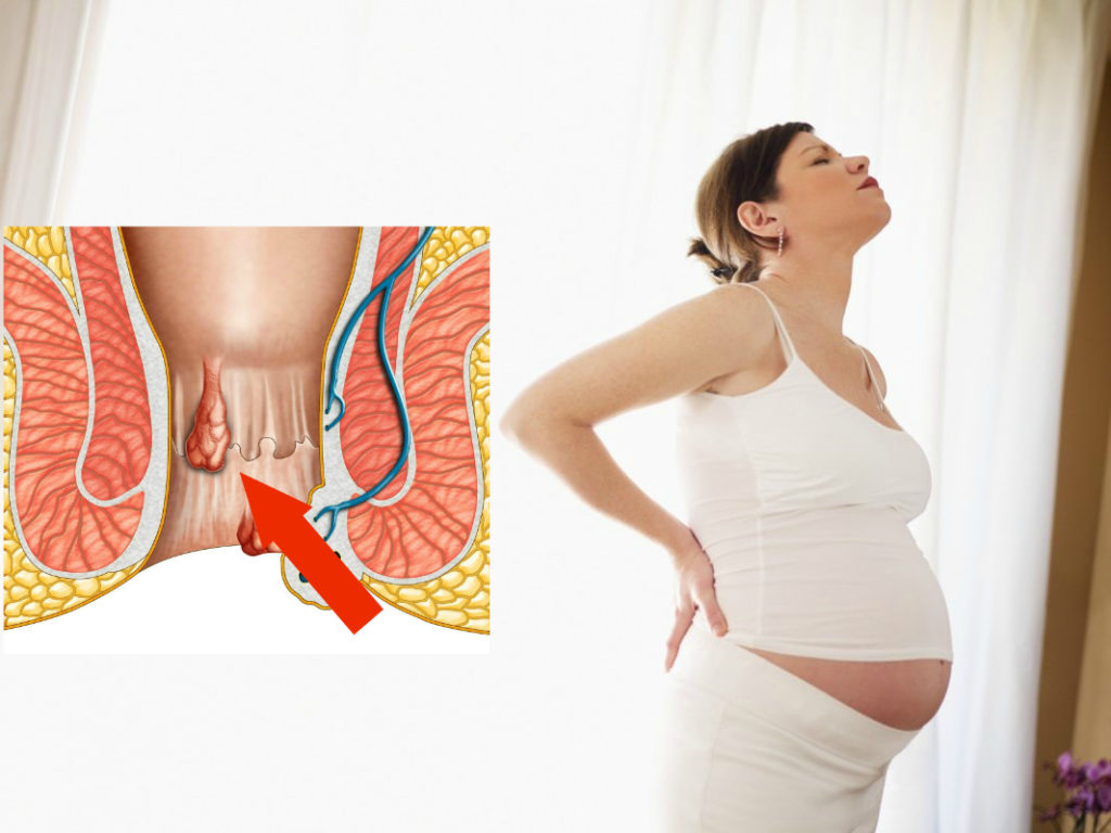 Геморрой при беременности: причины, симптомы и лечение геморроя у беременных - yod.ua