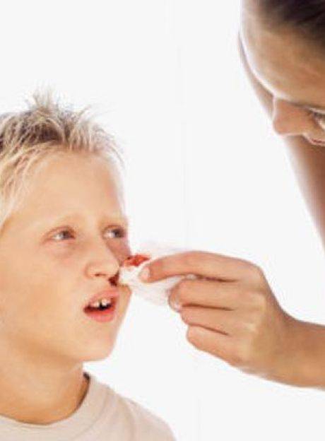 Носовое кровотечение: причины, симптомы, методы лечения
