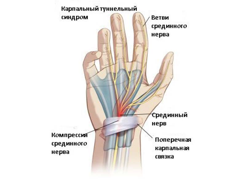 Немеет левая рука — что может вызвать данный симптом