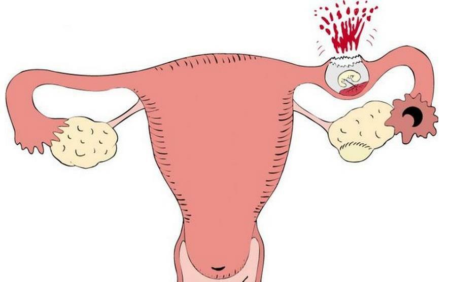 Что такое внематочная беременность, как её определить и что делать?