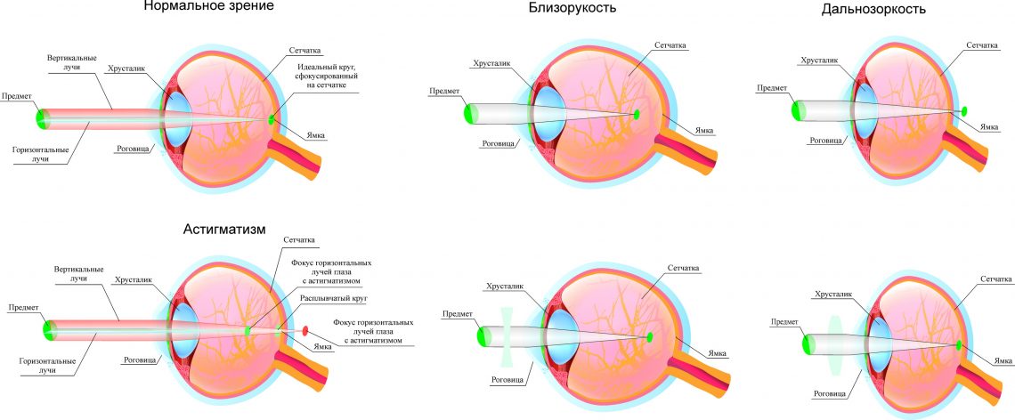 В какой части глазного яблока происходит фокусировка изображения у людей с близорукостью